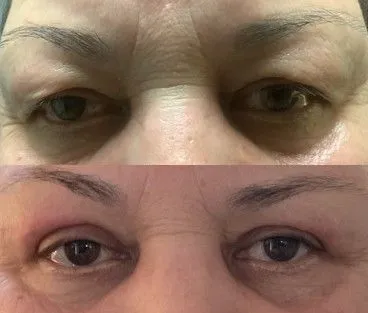 blepharoplasty-surgeon-phoenix-glendale-mesa-gilbert-arizona-az