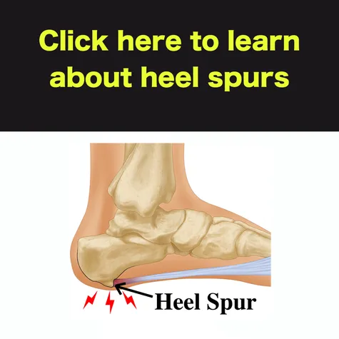 heel spurs