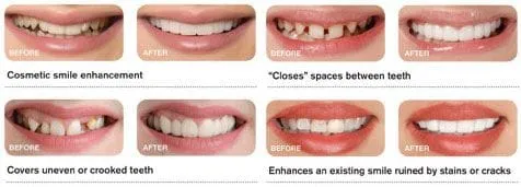 Take a look at what Snap on Smile can do!