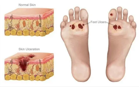 Ingrown Toenail Surgery - Council Bluffs Foot & Ankle Care, PC