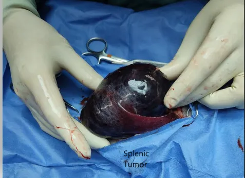 tumor removed