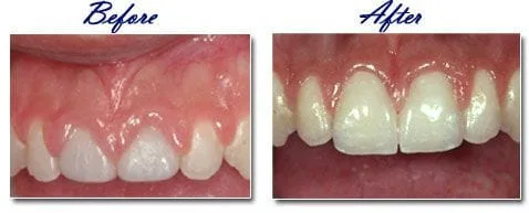 before and after images of teeth after crown lengthening, periodontist Mahwah, NJ