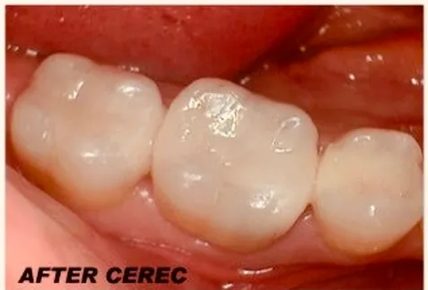 After Cerec