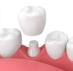 3D illustration of dental crown being placed over tooth, dentist Roslyn, NY dental crowns and bridges
