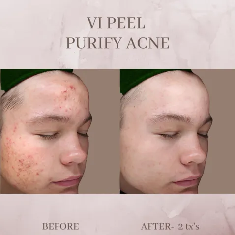 vipeel acne