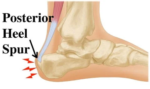 Heel Spur | Calcaneal Spur | Heel Pain Treatment | City Physiotherapy