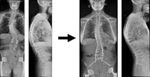 Scoliosis after Previous Fusion Surgery