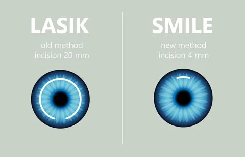 SMILE comparison graphic