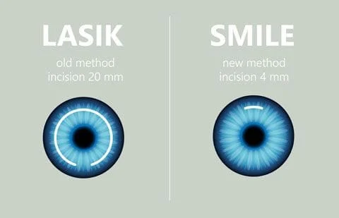 SMILE versus LASIK graphic