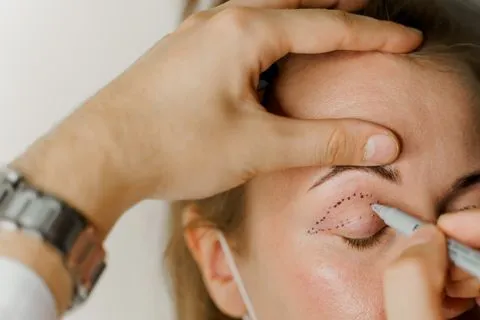 Doctor outlining eyelid surgery