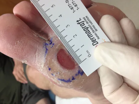 Diabetic Wound Before Dermagraft