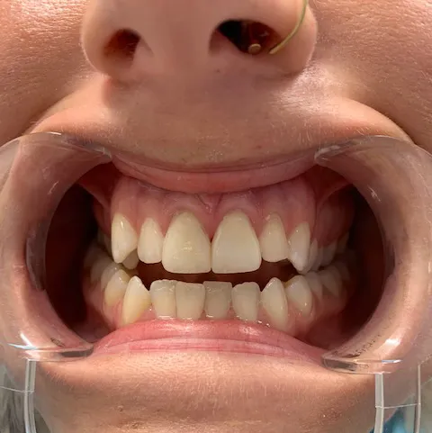 After - Best Dentist Fairfax, VA