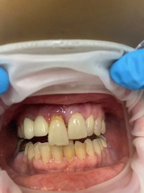 Before - Best Dentist Fairfax, VA