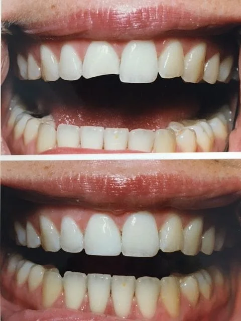 Before & After Photos, Cracked Tooth Repair Gallery