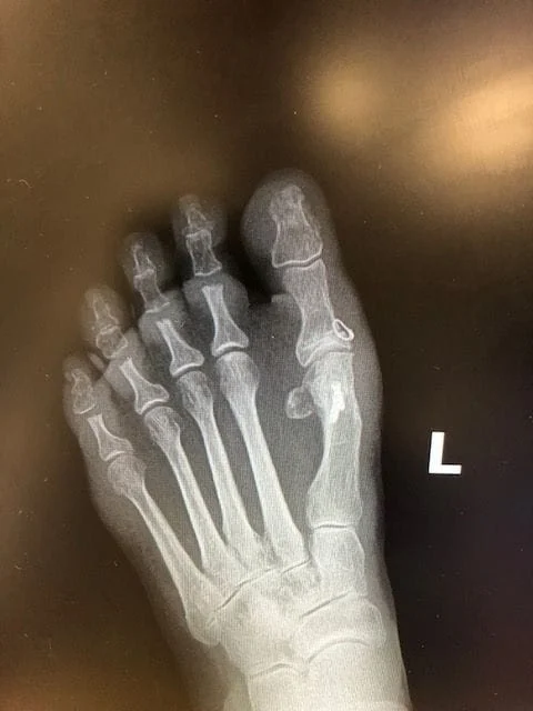  Left Foot After Surgery