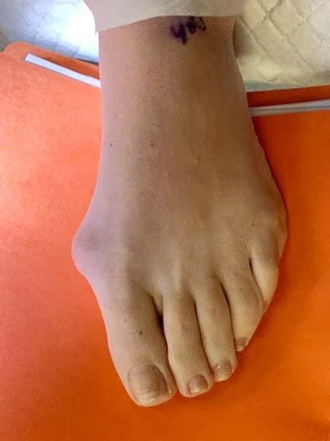 Left Foot Before Surgery 