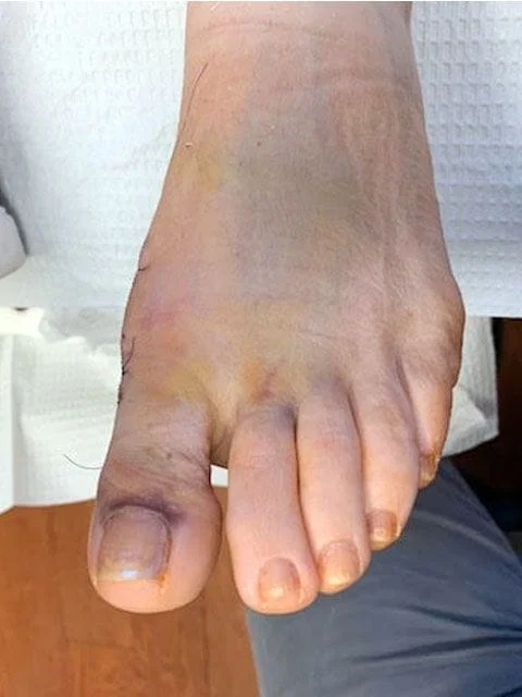  Left Foot After Surgery