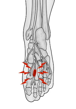 mortons neuroma