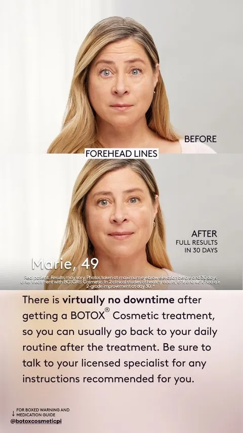 botox