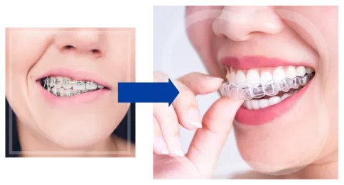 braces vs orthosnap