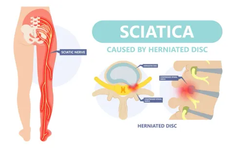 sciatica
