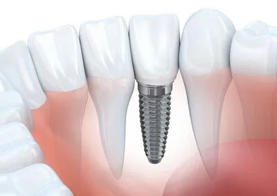 computer illustration of lower teeth and gums showing tooth roots and embedded implant, dental implants Little Falls, NJ dentist