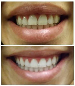 Phillips Zoom Teeth Whitening 