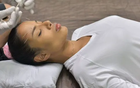 Women having acupuncture on her face