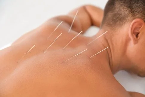 Man with acupuncture needles on back