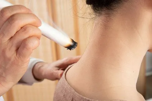 Women getting Moxibustion on neck