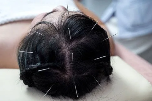 Scalp with acupuncture needles