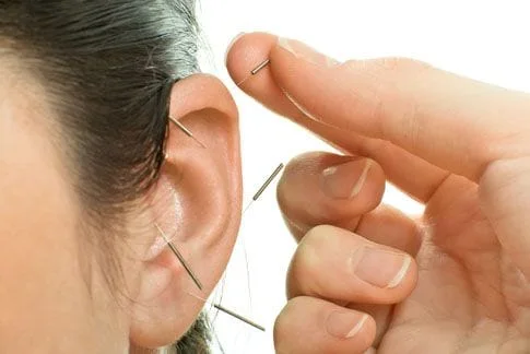 Ear with acu needles