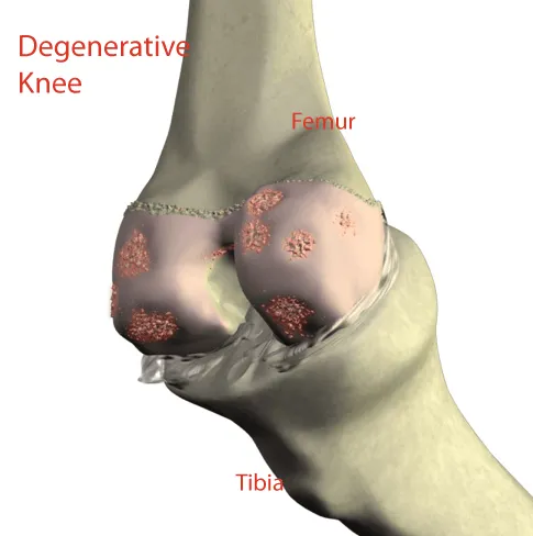 knee pain supartz injection.  Example of a degenerative knee that has damage to the joint