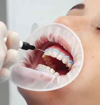 upper and lower teeth whitening trays and two applicators for solution, zoom teeth whitening Melrose, MA cosmetic dentistry