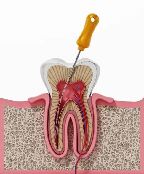 root canal