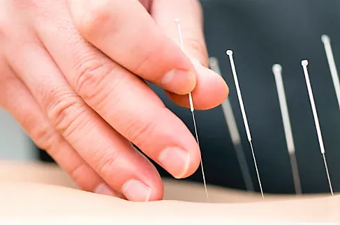 Acupuncture