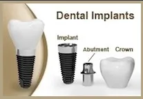 implantes dentales precio