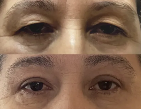 Blepharoplasty-Phoenix-Cave-Creek-Scottsdale