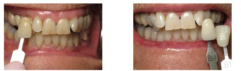 Zoom Whitening Systems