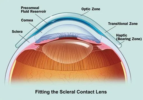 Example of how a scleral lens sits on the eye