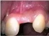 dental_implants