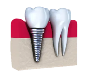 Dental Implants Stamford