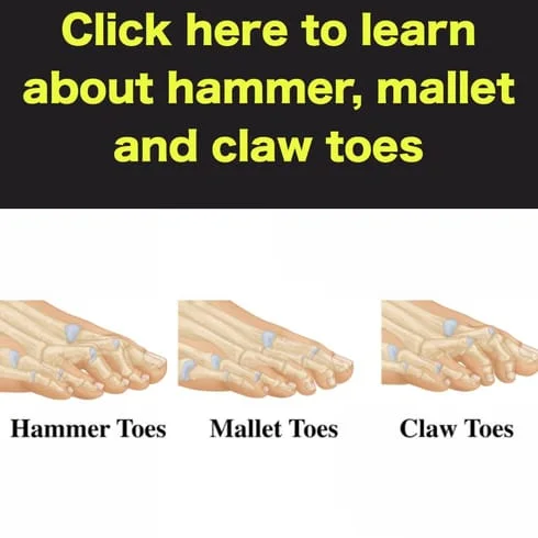 hammer mallet and claw toes