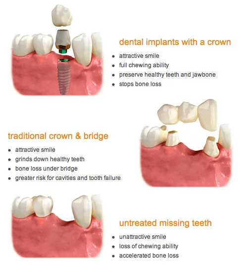 dental implants