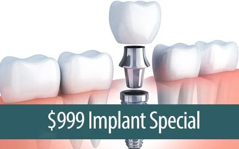 $999 Implant Special - Dental Implants Tracy CA