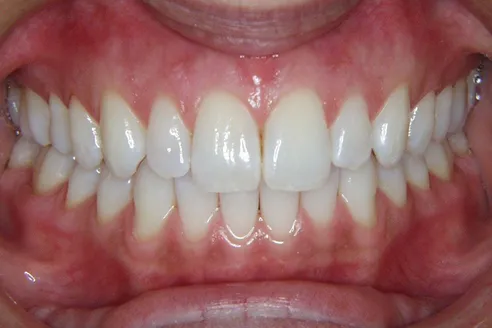 healthy gums