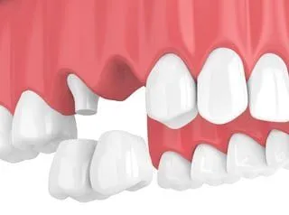 3D illustration of cantilever dental bridge, dentist Lubbock, TX
