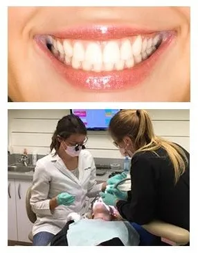 Bonding and white fillings