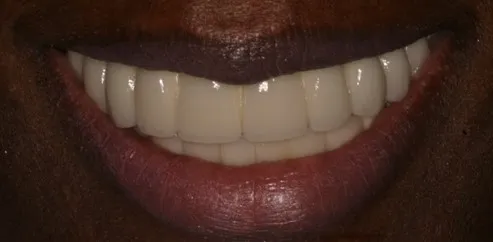 After by Dr. Asya Shor, North Babylon Dental
