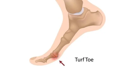 turf toe treatment sheboygan wi